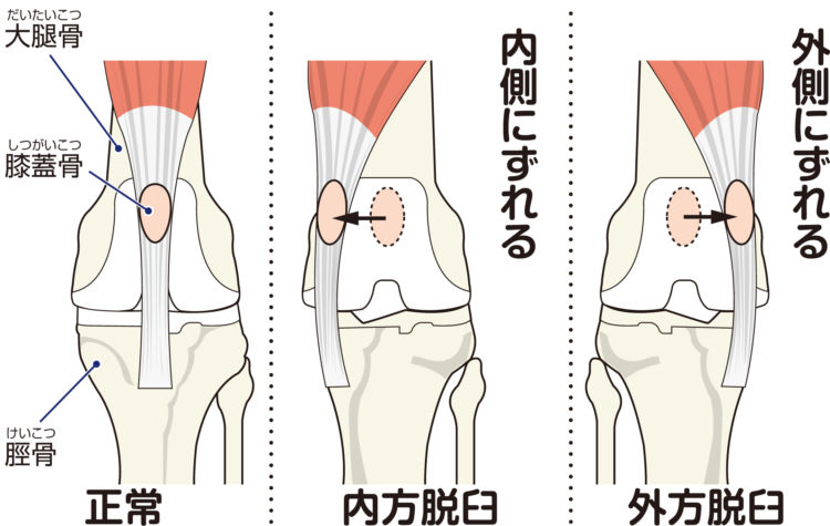 膝蓋骨脱臼の図　パテラ